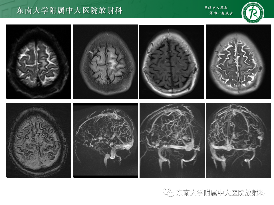 影像PPT - 【PPT】颅内多发钙化病例随诊-5