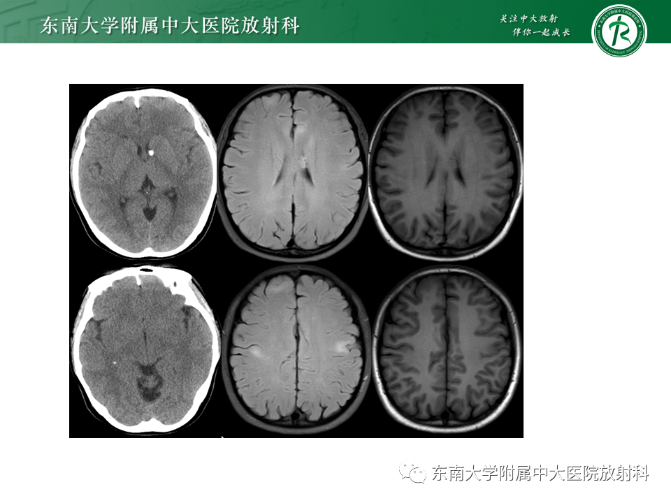 影像PPT - 【PPT】颅内多发钙化病例随诊-7