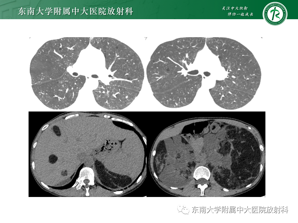 影像PPT - 【PPT】颅内多发钙化病例随诊-8