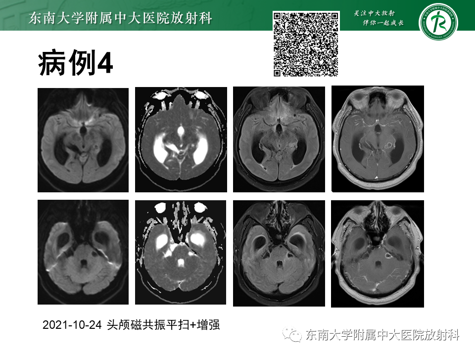 影像PPT - 【PPT】颅内多发钙化病例随诊-10