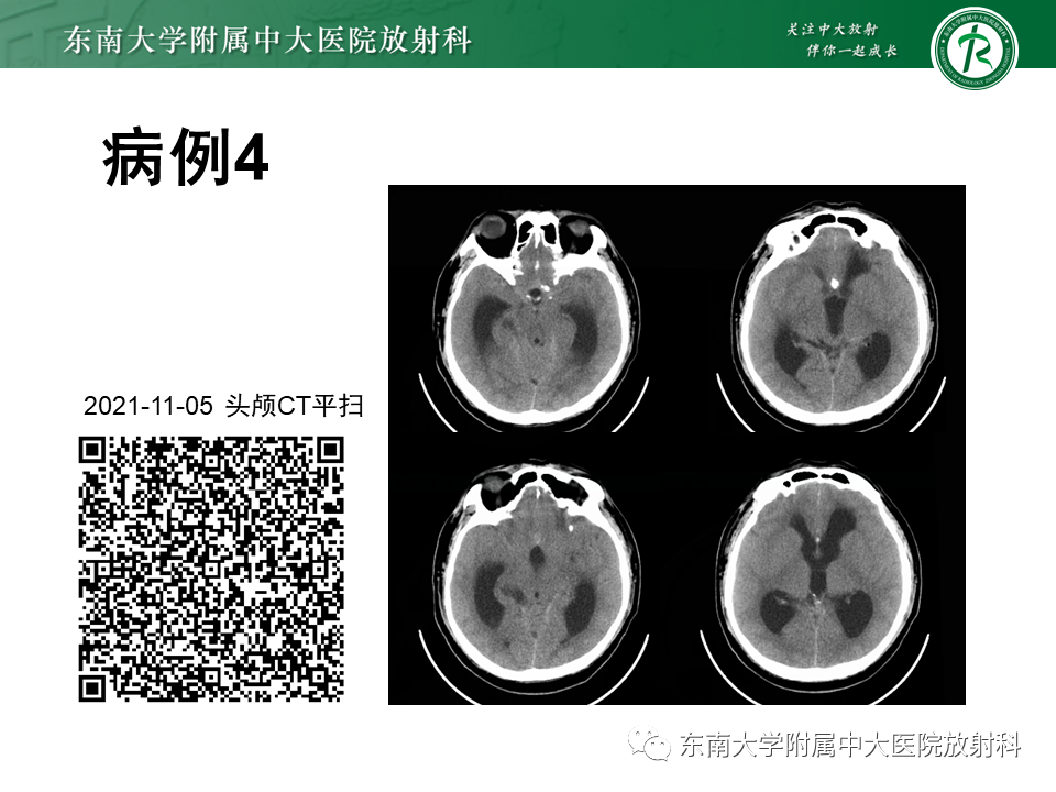 影像PPT - 【PPT】颅内多发钙化病例随诊-11