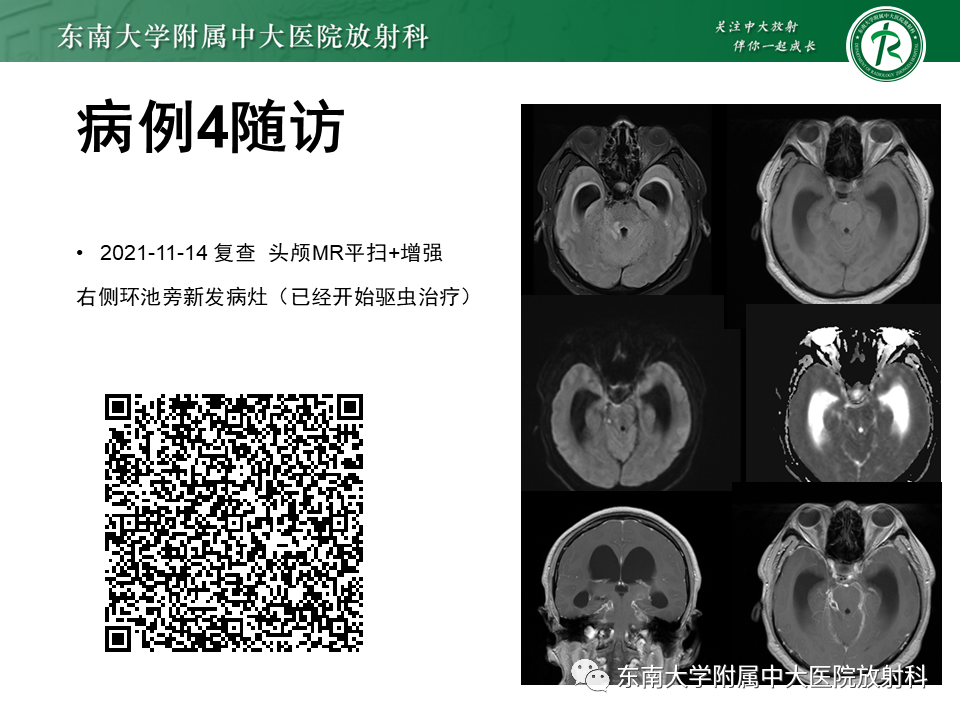 影像PPT - 【PPT】颅内多发钙化病例随诊-16