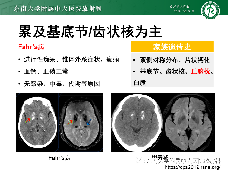 影像PPT - 【PPT】颅内多发钙化病例随诊-24