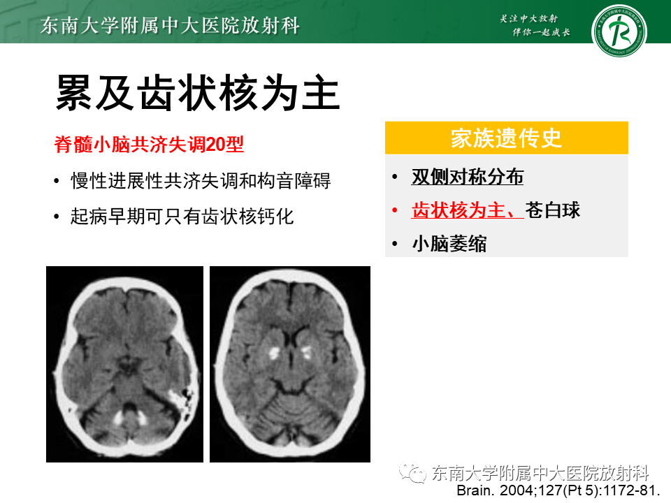 影像PPT - 【PPT】颅内多发钙化病例随诊-25