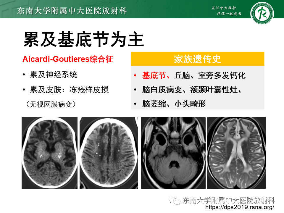 影像PPT - 【PPT】颅内多发钙化病例随诊-26