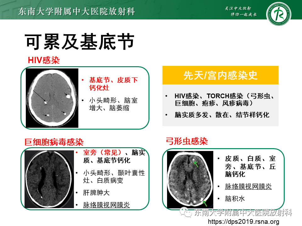 影像PPT - 【PPT】颅内多发钙化病例随诊-28