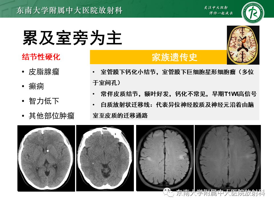 影像PPT - 【PPT】颅内多发钙化病例随诊-31