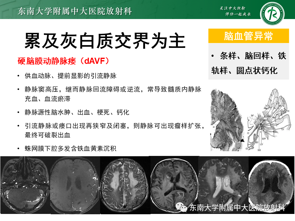 影像PPT - 【PPT】颅内多发钙化病例随诊-36