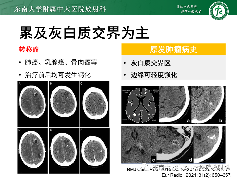 影像PPT - 【PPT】颅内多发钙化病例随诊-34