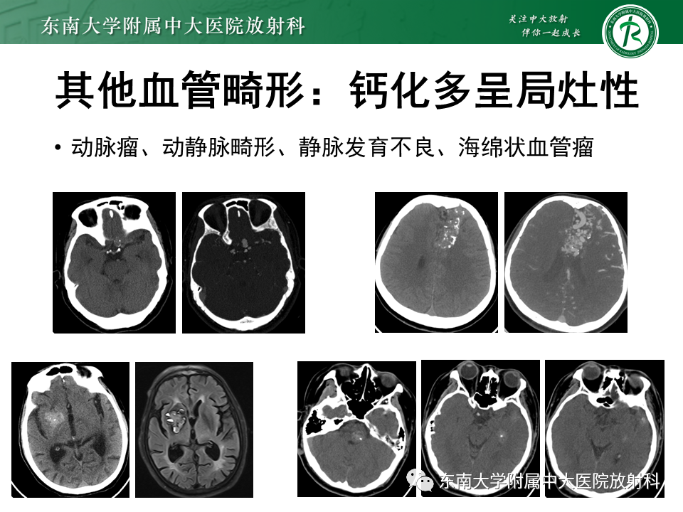 影像PPT - 【PPT】颅内多发钙化病例随诊-37