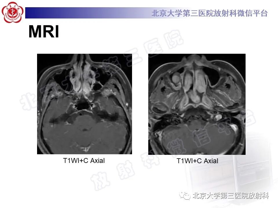 影像PPT - 【PPT】嗅神经母细胞瘤-4