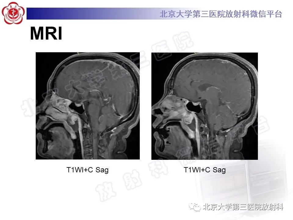 影像PPT - 【PPT】嗅神经母细胞瘤-5