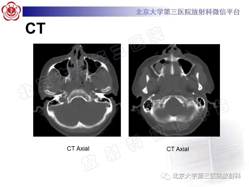 影像PPT - 【PPT】嗅神经母细胞瘤-3