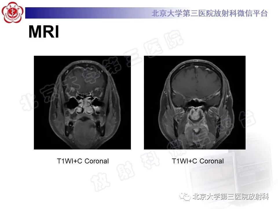 影像PPT - 【PPT】嗅神经母细胞瘤-6