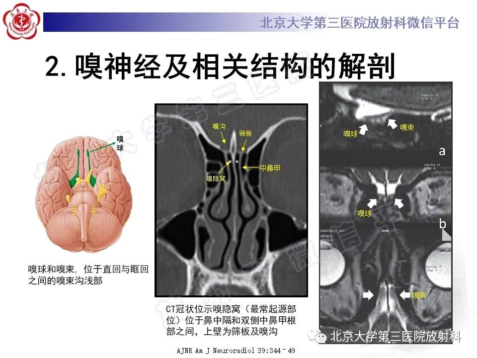 影像PPT - 【PPT】嗅神经母细胞瘤-13
