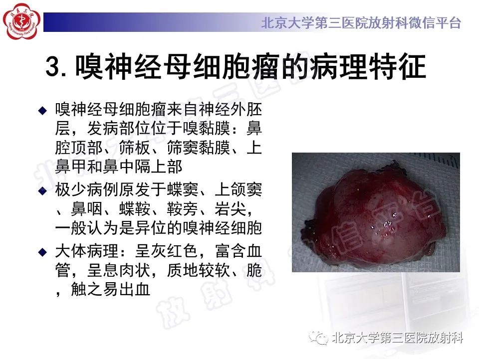 影像PPT - 【PPT】嗅神经母细胞瘤-14
