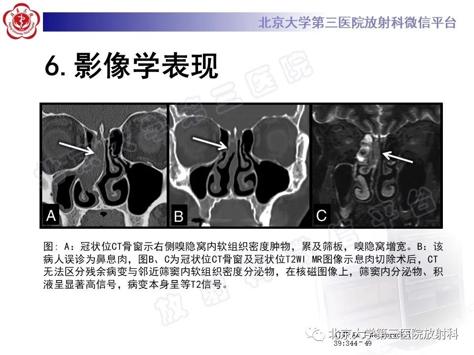 影像PPT - 【PPT】嗅神经母细胞瘤-22