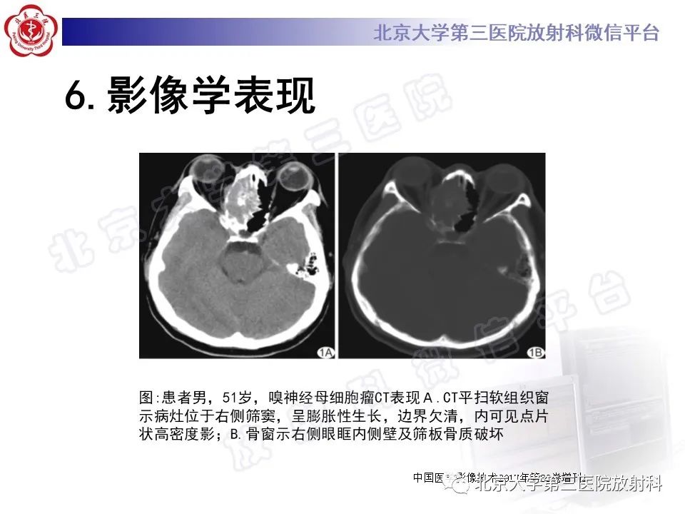 影像PPT - 【PPT】嗅神经母细胞瘤-23