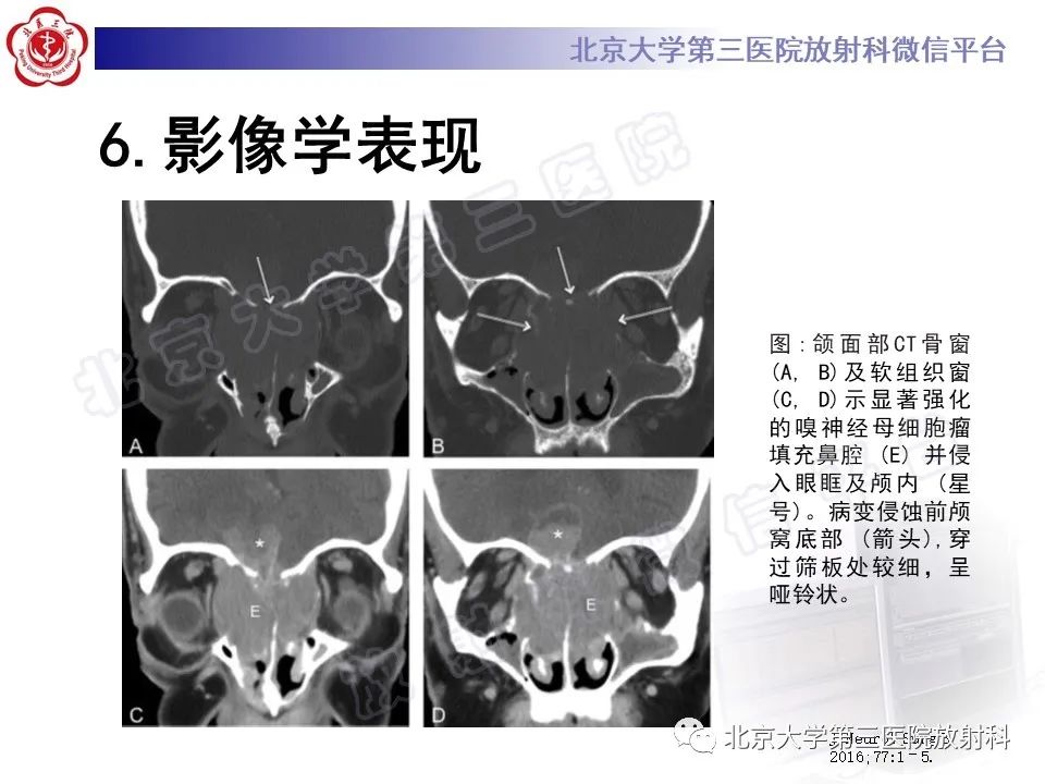 影像PPT - 【PPT】嗅神经母细胞瘤-24