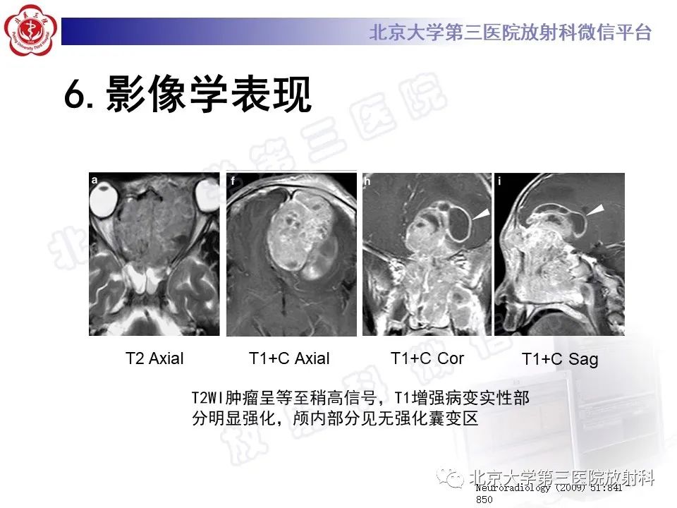 影像PPT - 【PPT】嗅神经母细胞瘤-26