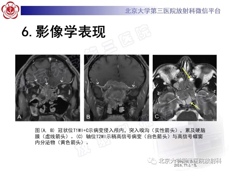 影像PPT - 【PPT】嗅神经母细胞瘤-25