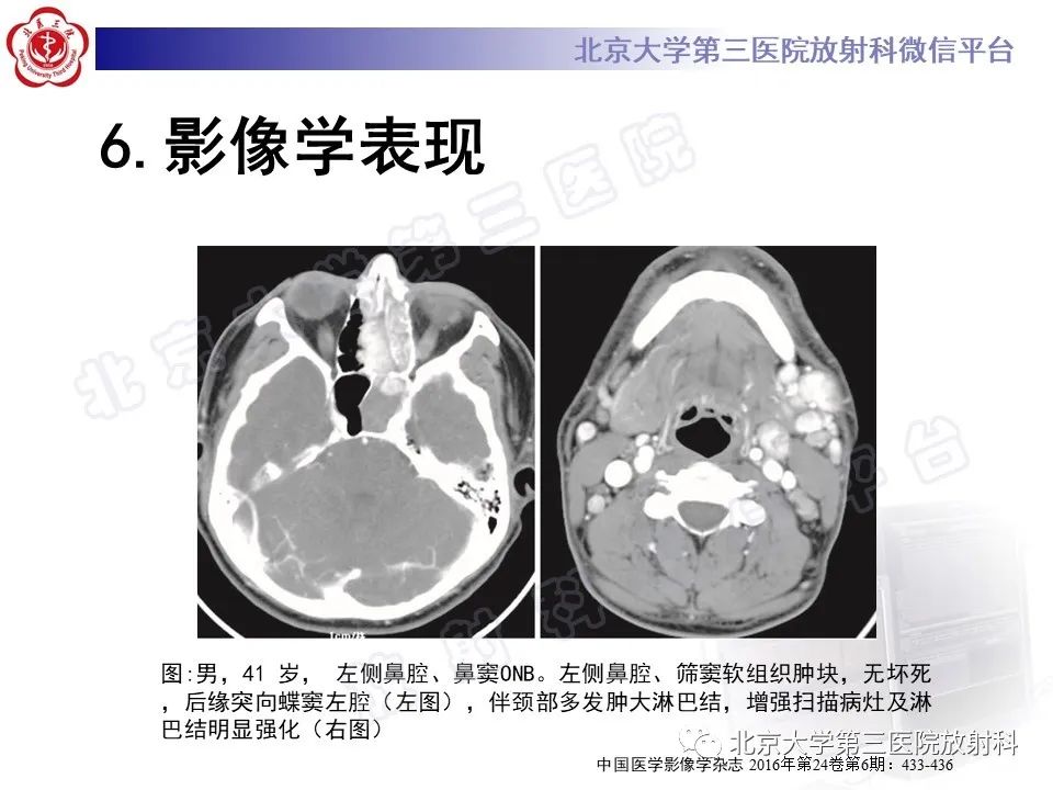 影像PPT - 【PPT】嗅神经母细胞瘤-27