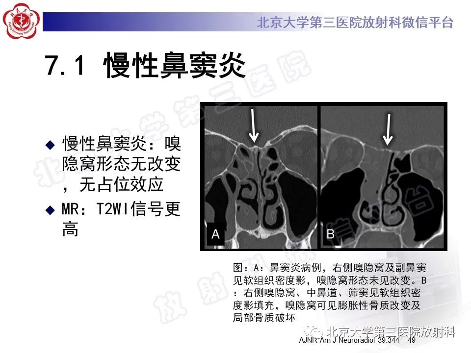 影像PPT - 【PPT】嗅神经母细胞瘤-29
