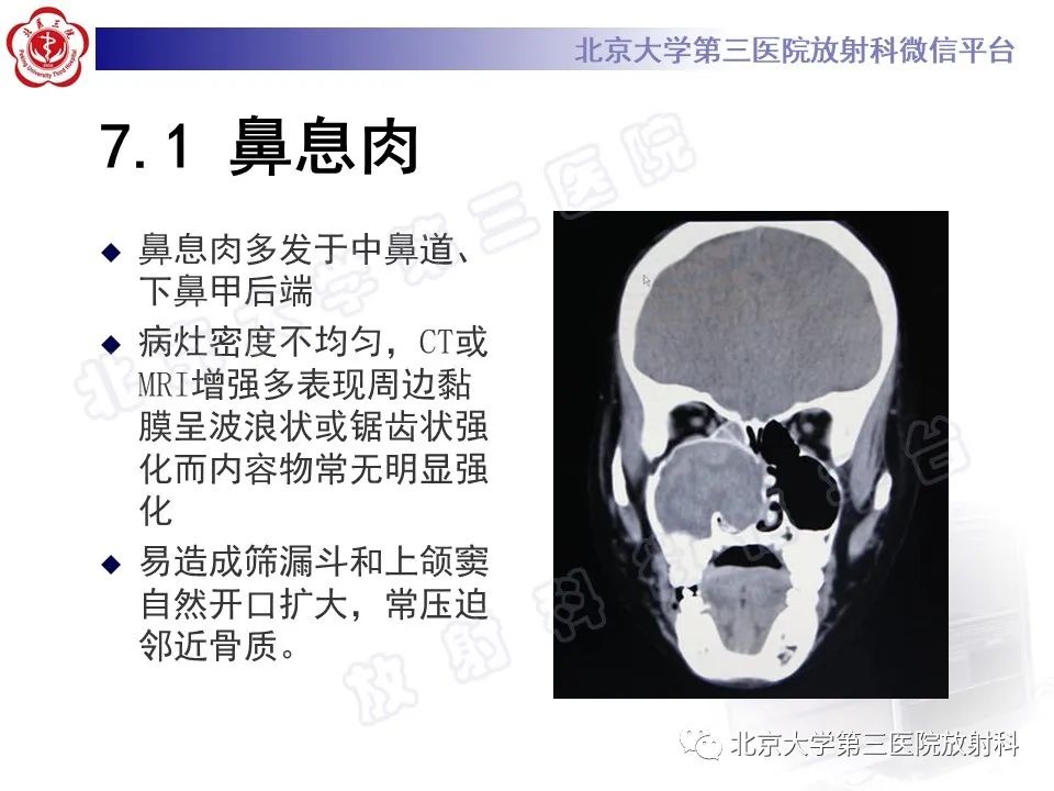 影像PPT - 【PPT】嗅神经母细胞瘤-30