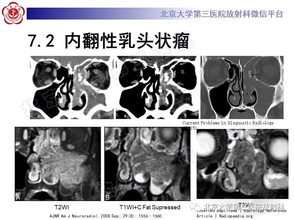 影像PPT - 【PPT】嗅神经母细胞瘤-32