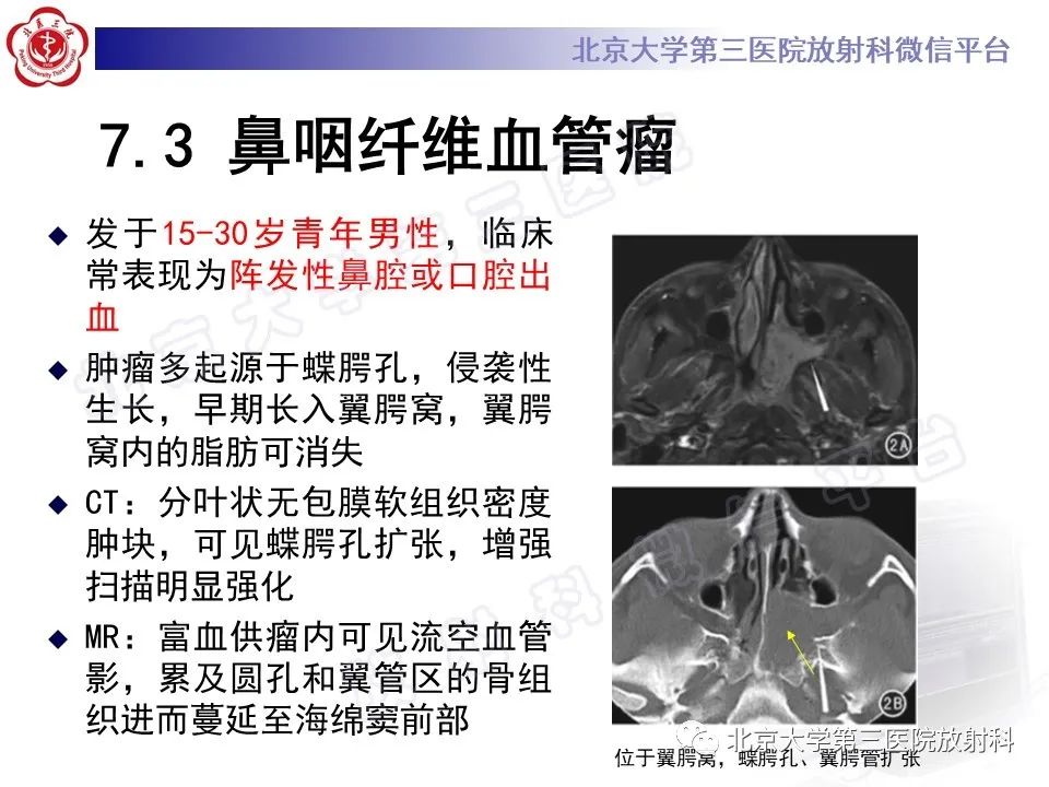影像PPT - 【PPT】嗅神经母细胞瘤-33