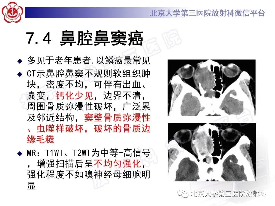 影像PPT - 【PPT】嗅神经母细胞瘤-34