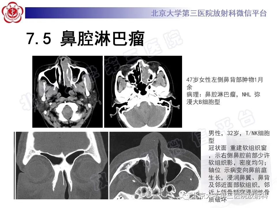 影像PPT - 【PPT】嗅神经母细胞瘤-36