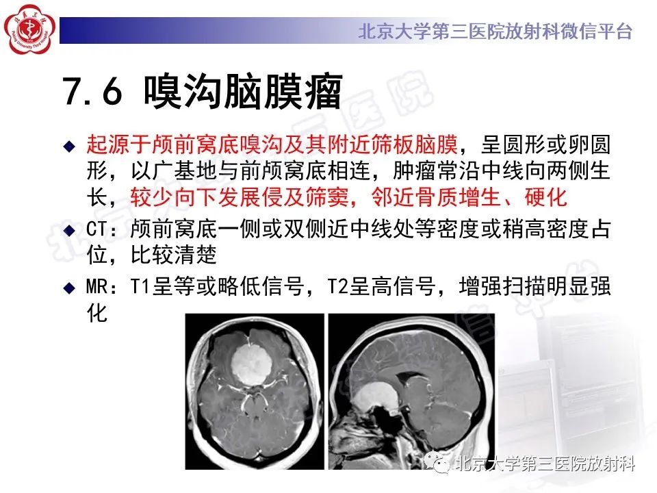 影像PPT - 【PPT】嗅神经母细胞瘤-37