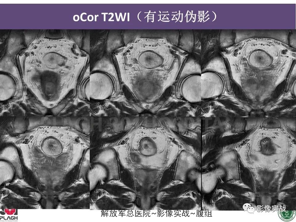 影像PPT - 【病例】直肠腺瘤1例MR影像-5