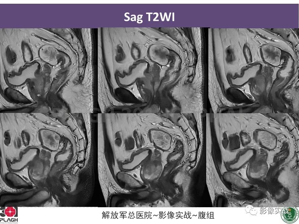 影像PPT - 【病例】直肠腺瘤1例MR影像-4