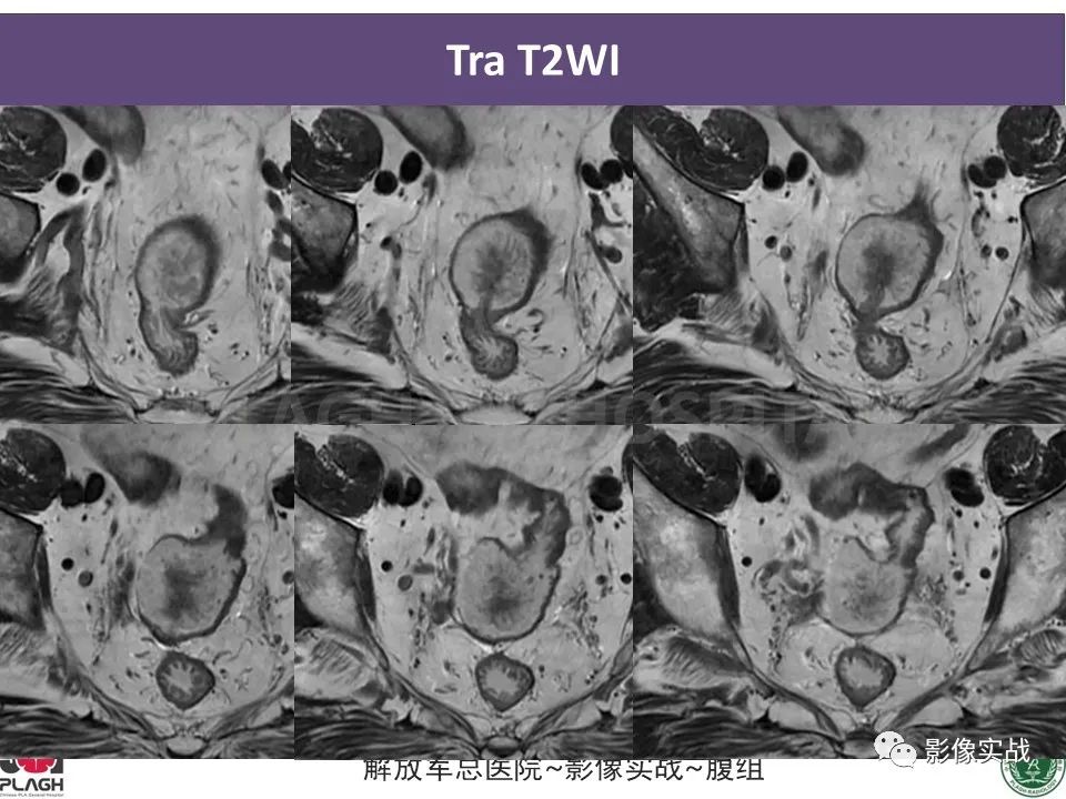 影像PPT - 【病例】直肠腺瘤1例MR影像-6