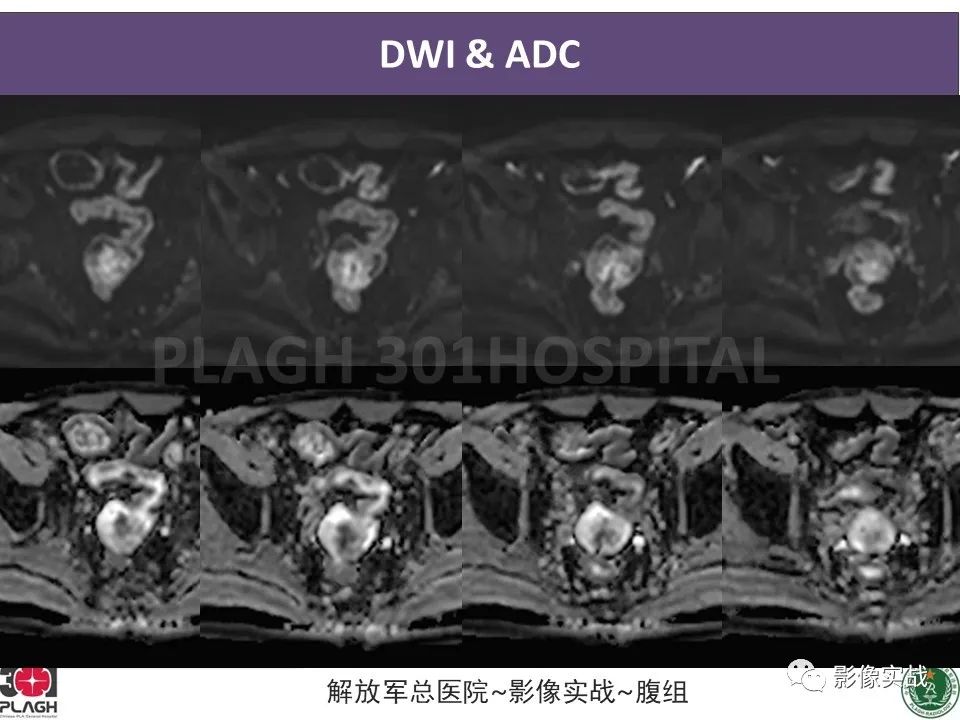 影像PPT - 【病例】直肠腺瘤1例MR影像-7