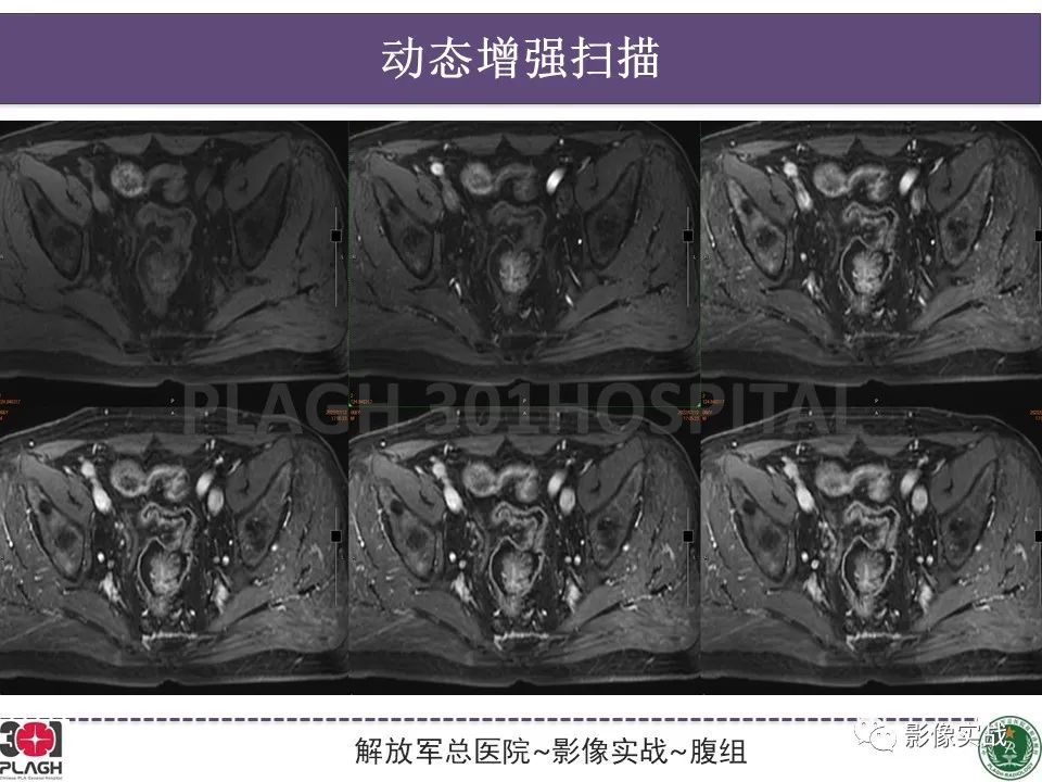 影像PPT - 【病例】直肠腺瘤1例MR影像-8
