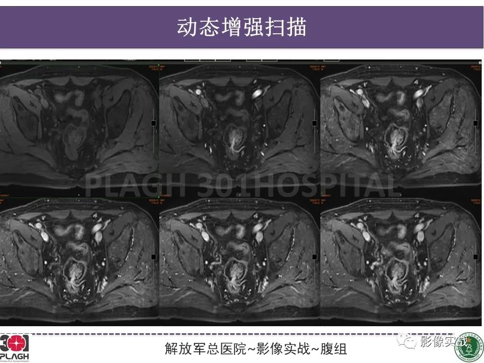 影像PPT - 【病例】直肠腺瘤1例MR影像-9