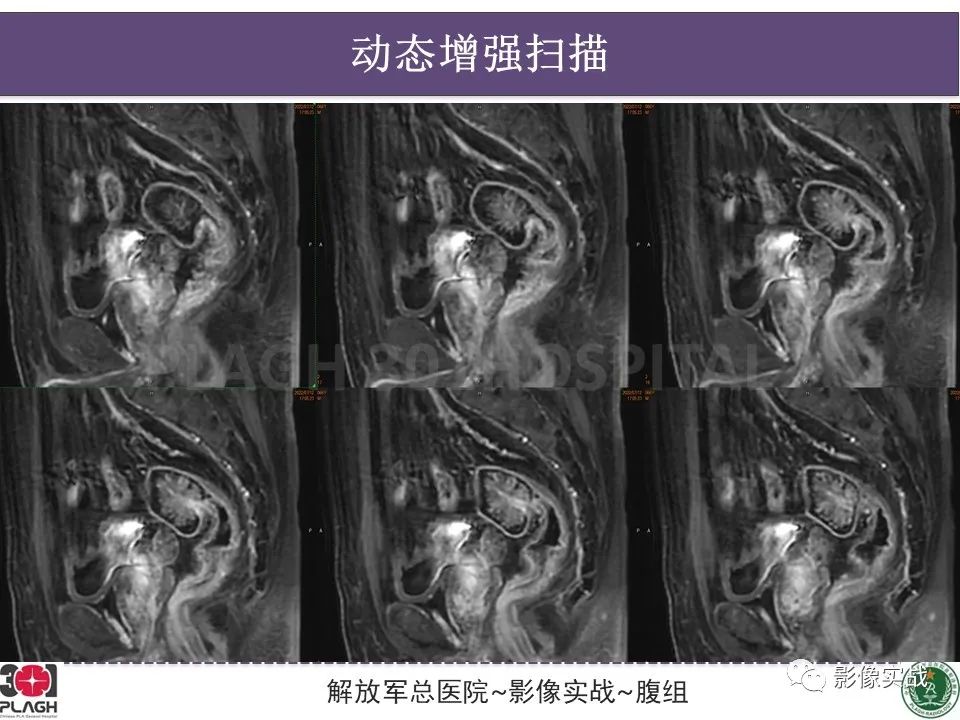 影像PPT - 【病例】直肠腺瘤1例MR影像-10