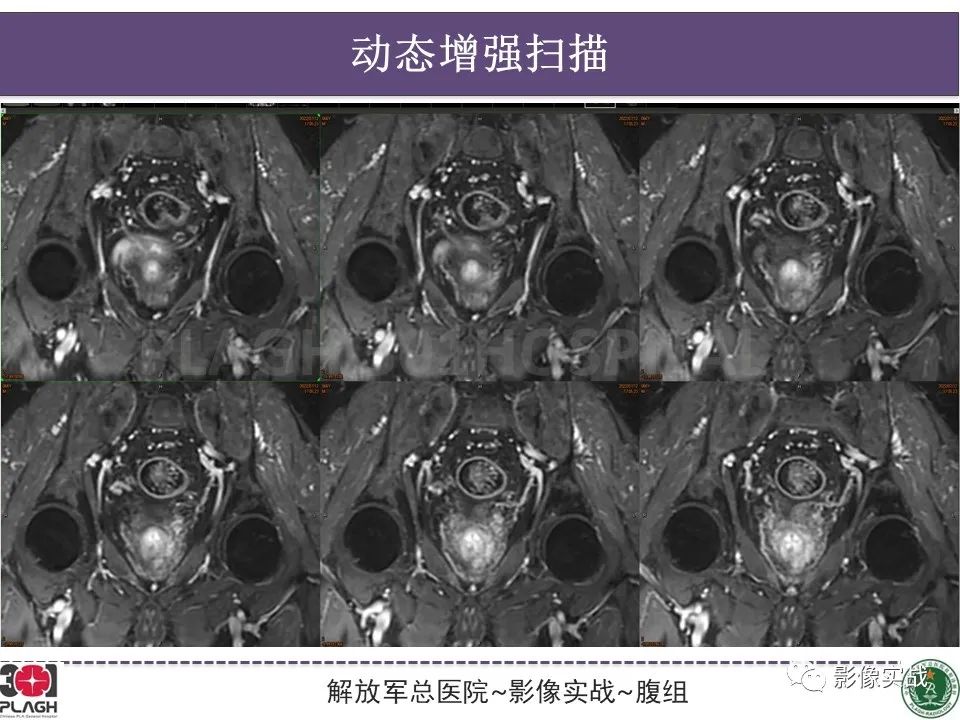 影像PPT - 【病例】直肠腺瘤1例MR影像-11