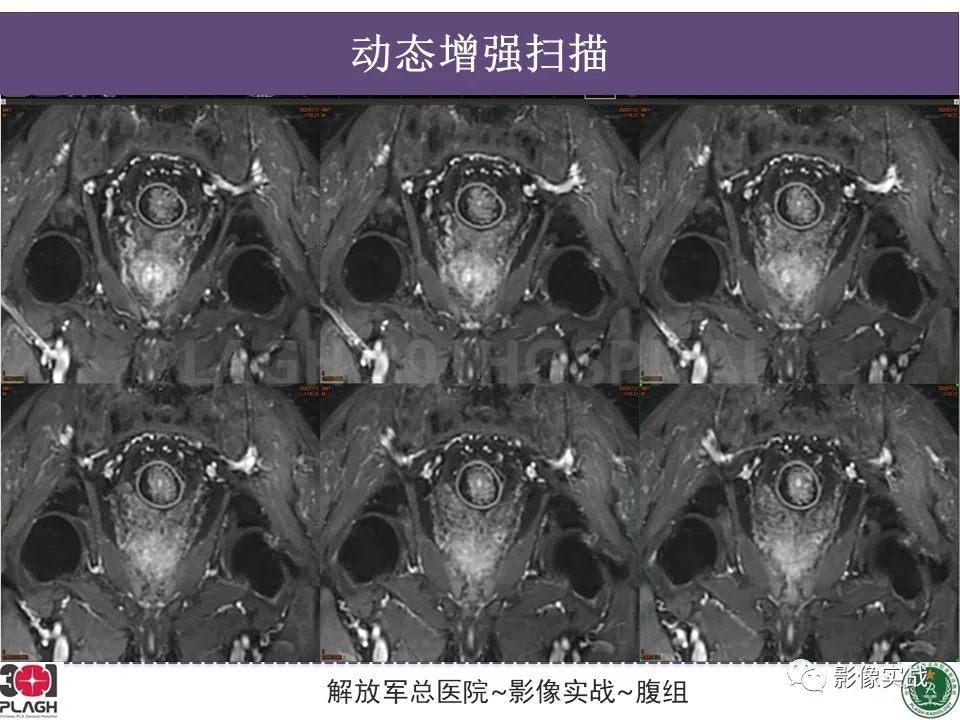 影像PPT - 【病例】直肠腺瘤1例MR影像-12
