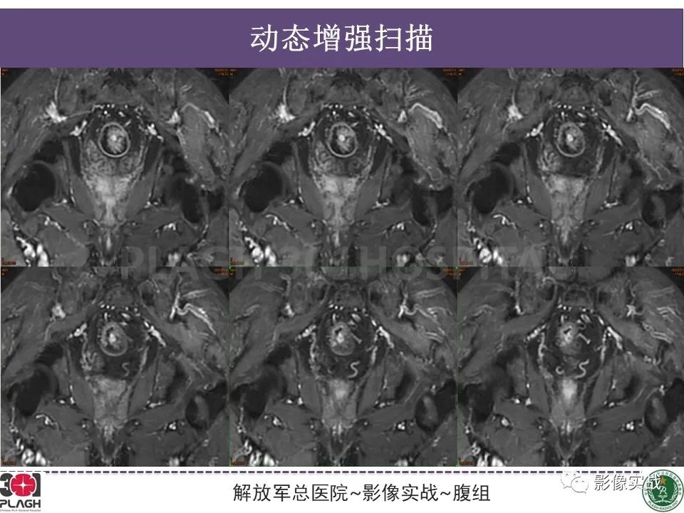 影像PPT - 【病例】直肠腺瘤1例MR影像-13