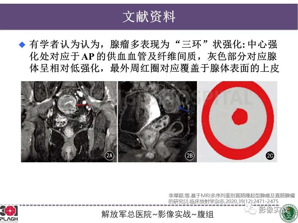 影像PPT - 【病例】直肠腺瘤1例MR影像-28