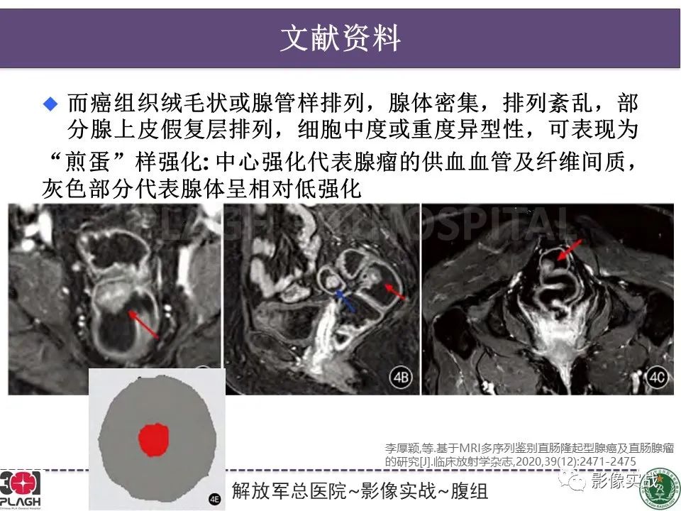 影像PPT - 【病例】直肠腺瘤1例MR影像-29