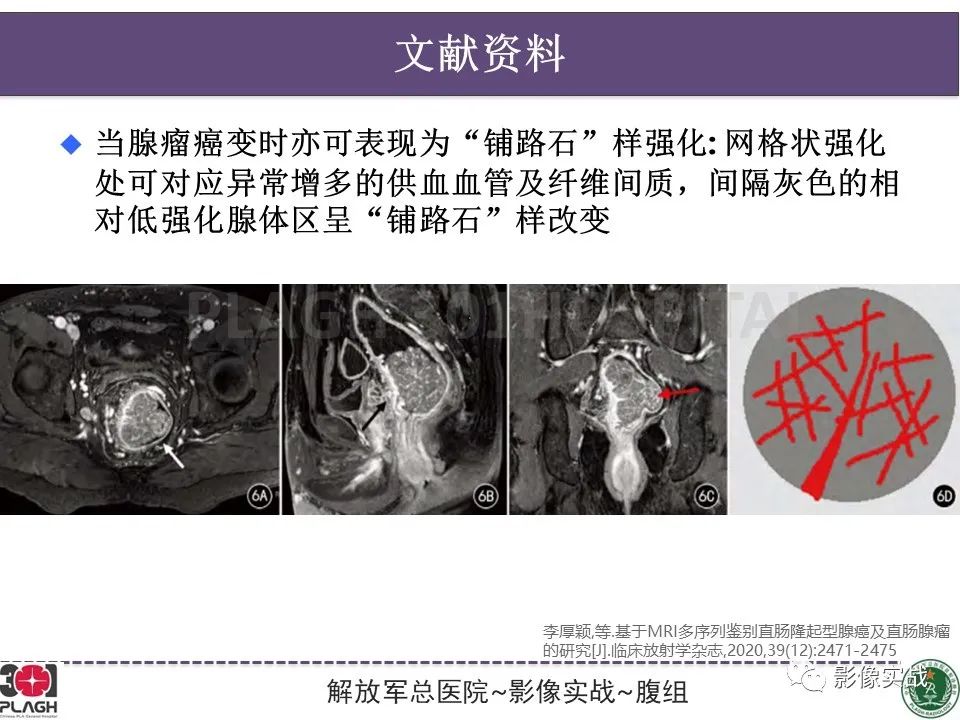 影像PPT - 【病例】直肠腺瘤1例MR影像-30