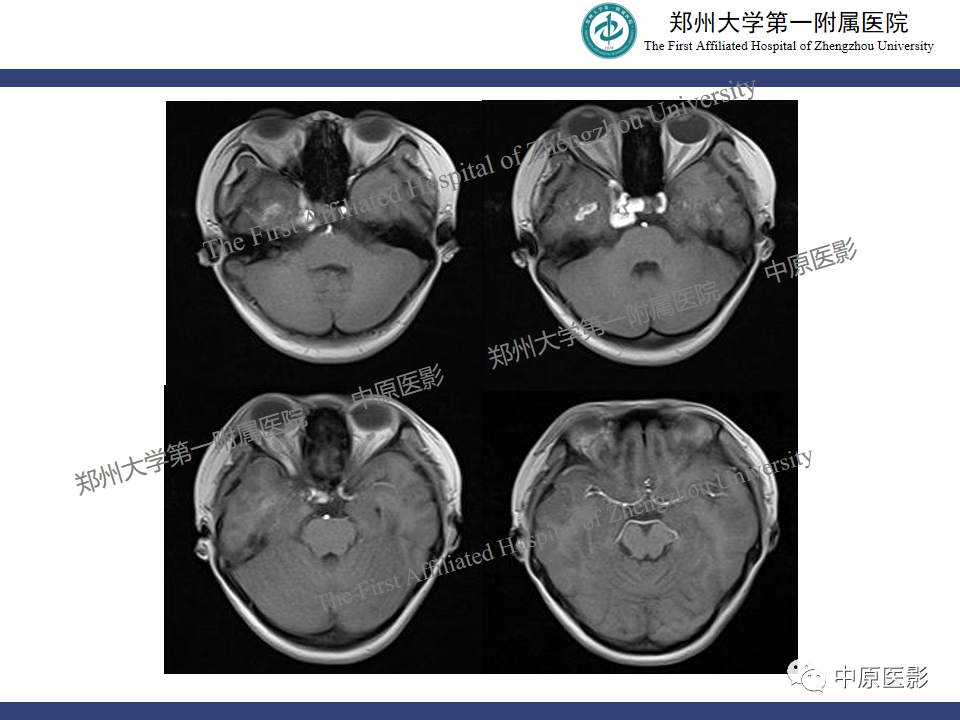 影像PPT - 【病例】颈动脉海绵窦瘘1例MR影像-4