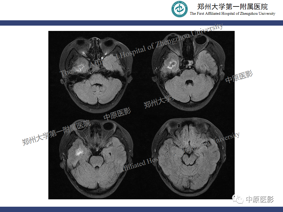 影像PPT - 【病例】颈动脉海绵窦瘘1例MR影像-5