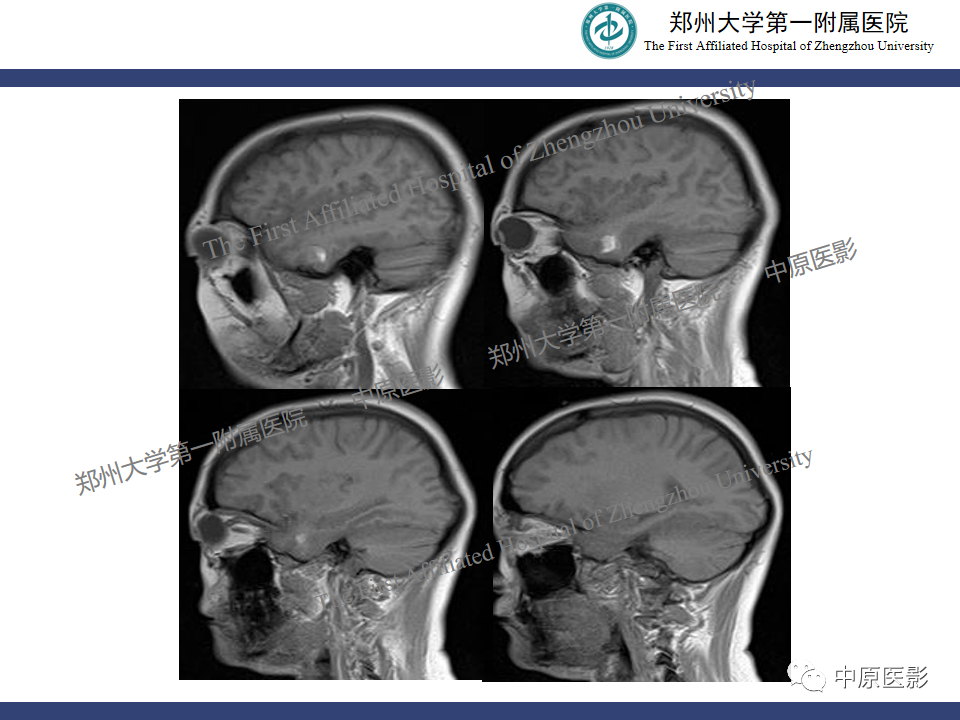 影像PPT - 【病例】颈动脉海绵窦瘘1例MR影像-6