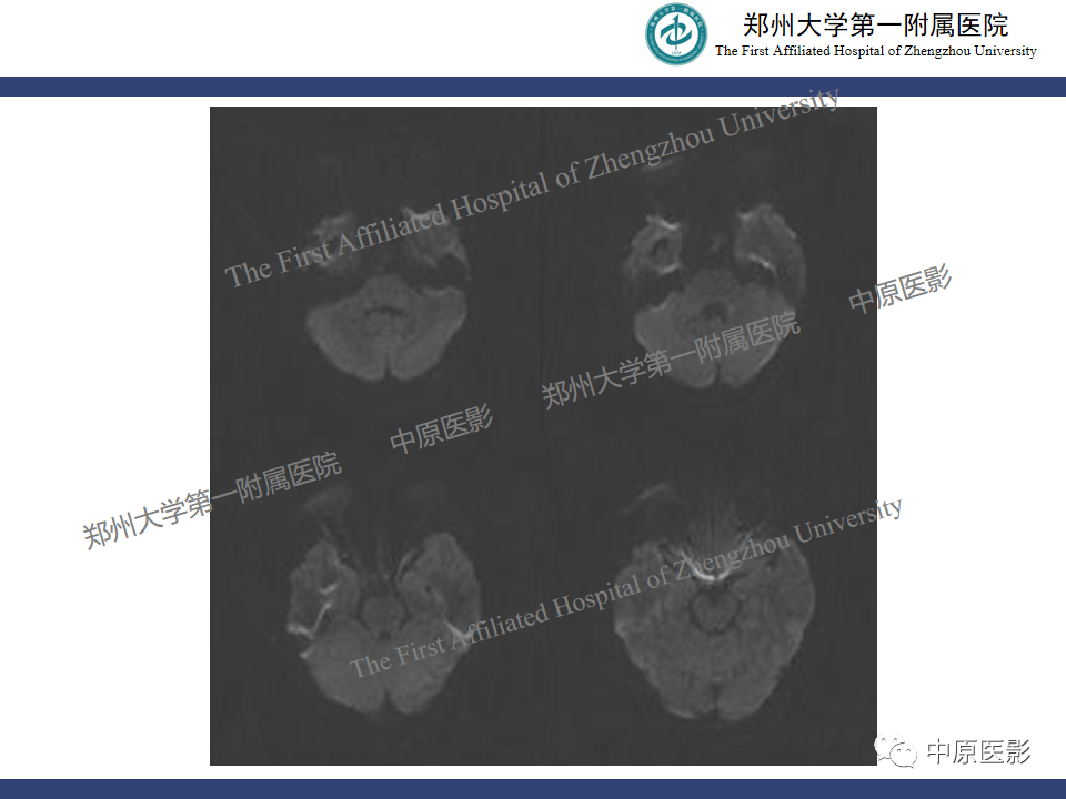影像PPT - 【病例】颈动脉海绵窦瘘1例MR影像-7